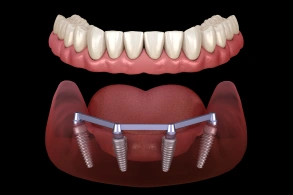 Dental implant prosthesis demonstration showing upper denture and lower jaw model with implant fixtures.