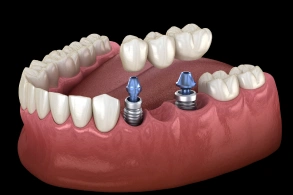 Dental implants illustration showing two blue titanium implants inserted in jawbone with artificial teeth above.