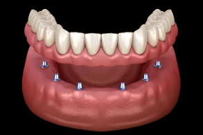 Dental implant diagram showing lower jaw anatomy with implant posts marked for tooth replacement.