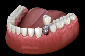 Dental implant illustration showing replacement tooth fixture in lower jaw model with surrounding teeth and gum tissue.