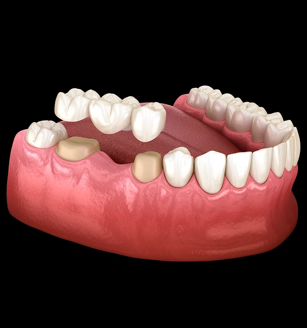 3D dental model showing upper and lower teeth with gum tissue on black background.