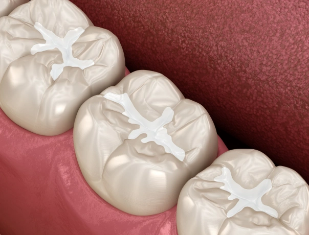 Three dental crowns displayed on pink gum model showing tooth restoration treatment options.