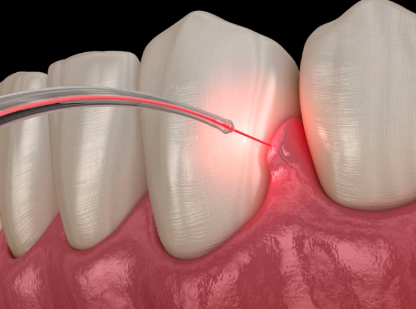 Dental implant illustration showing tooth with red glow indicating inflammation or infection in gum tissue.
