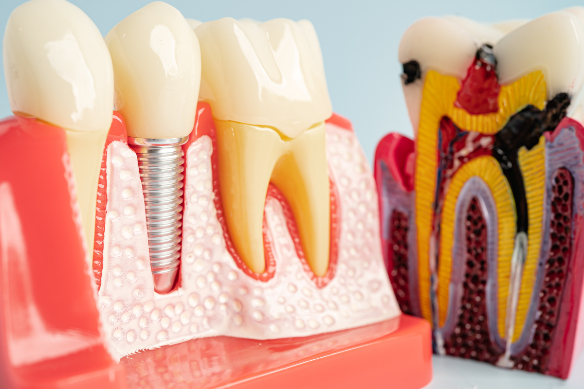 Root Canal Santa Cruz