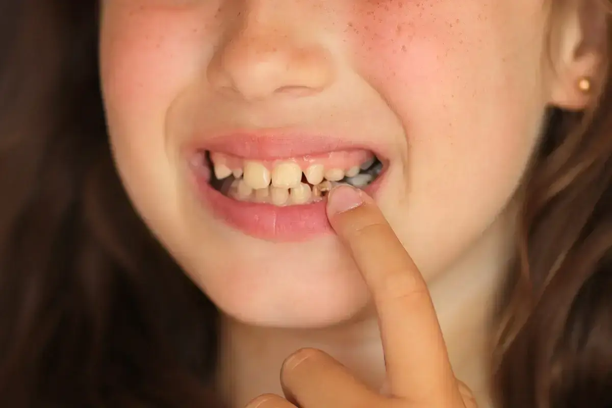 Child pointing to gap in baby teeth showing cavity risk and importance of dental care.