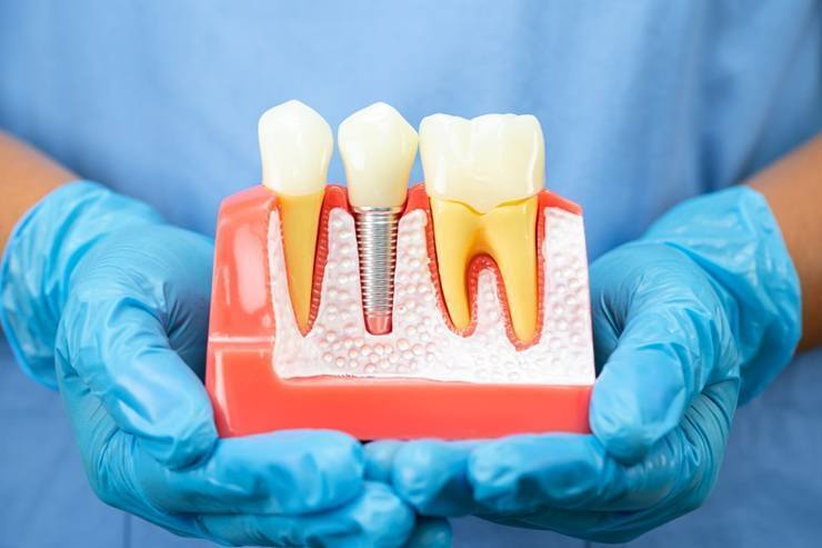 Dental implant model showing natural tooth, implant post, and crown restoration.